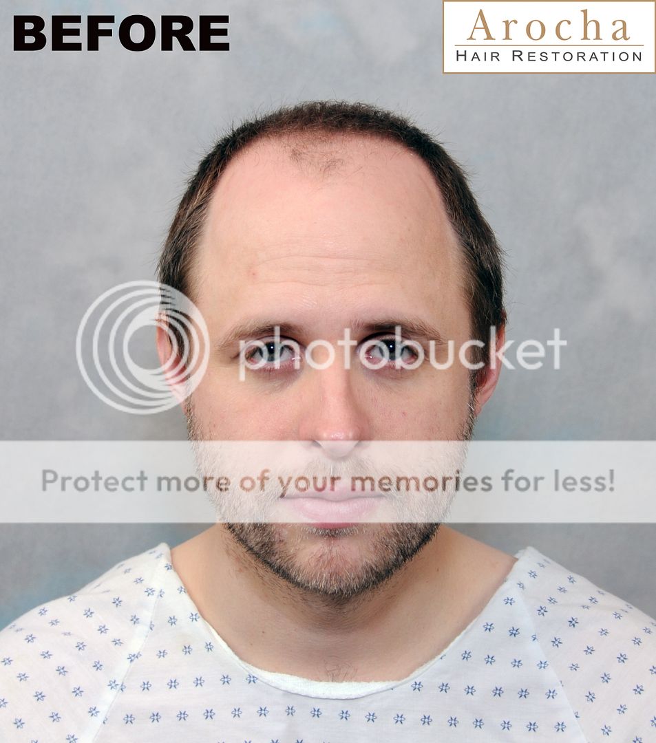Dr. AROCHA Restoration of the Frontal and Hairline Areas FUT 3005